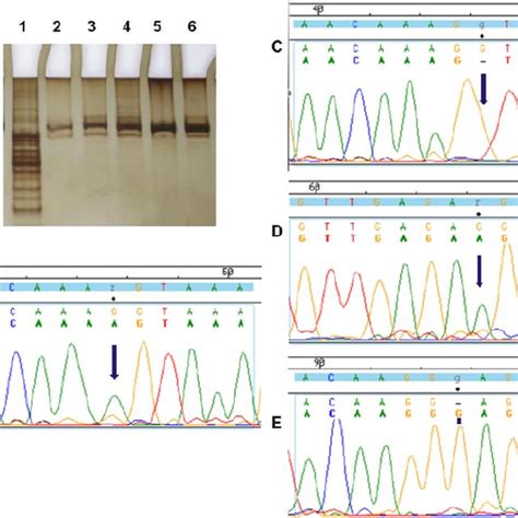 A Sscp Analysis Of The Pcr Products Of The Exon 1 Of Mbl2 Gene In Rhd