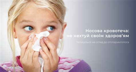 Носова кровотеча