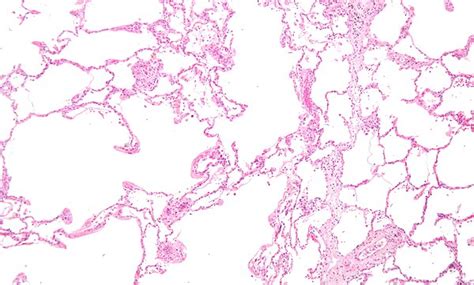 Emphysema - Libre Pathology