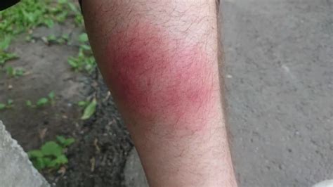 [35+] Укус мошки фото