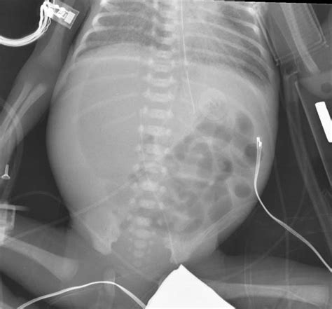 Pneumoperitoneum Wikidoc