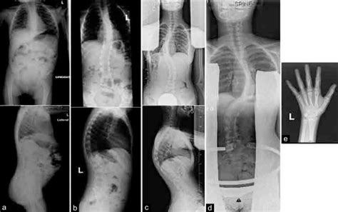 Serial Standing Scoliosis Radiographs A D Preoperative Ap And