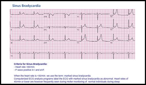 T20 Sinus Bradycardia Ecg Made Simple