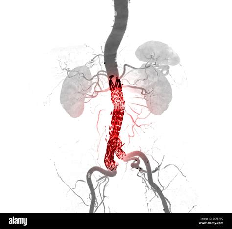 CTA whole aorta with Abdominal aorta stent graft compare 3D rendering ...