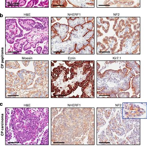 NHERF1 And ERM NF2 Expression In Normal And Transformed CP Provides New