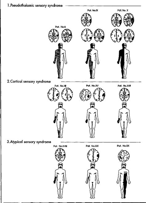 Sensory Syndromes In Parietal Stroke Semantic Scholar