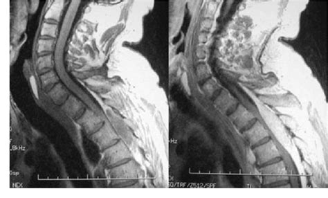 Figure From Case Study Of A Spinal Epidural Capillary Hemangioma A