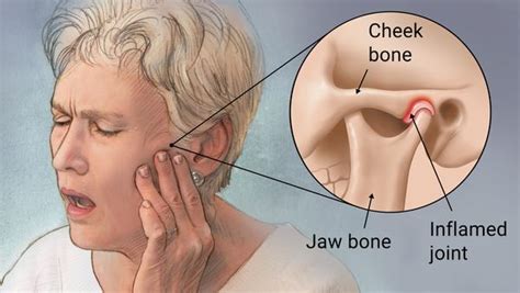 Temporomandibular Joint Disorder Dr Amini