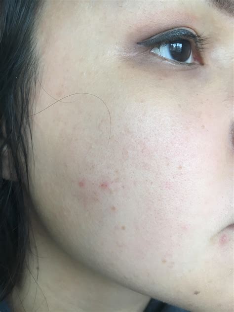 Closed Comedones Or Papules On Cheeks How To Make Them Go Away [acne] R Skincareaddiction