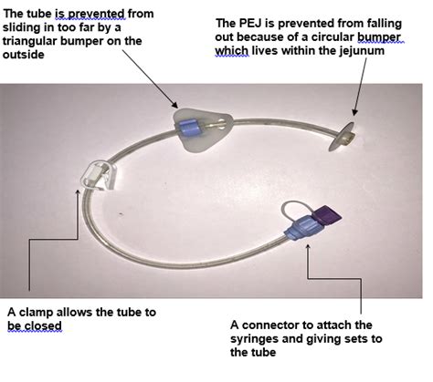 Percutaneous Endoscopic Gastrostomy PEG Tubes Cambridge 57 OFF