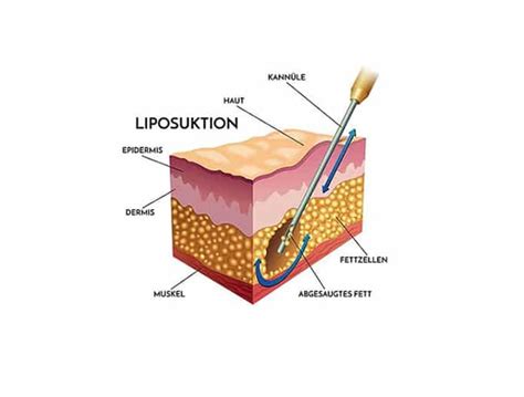 Liposuction An Overview Of The Different Techniques And Procedures