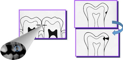 Radiographic Interpretation Of Dental Caries Flashcards Quizlet