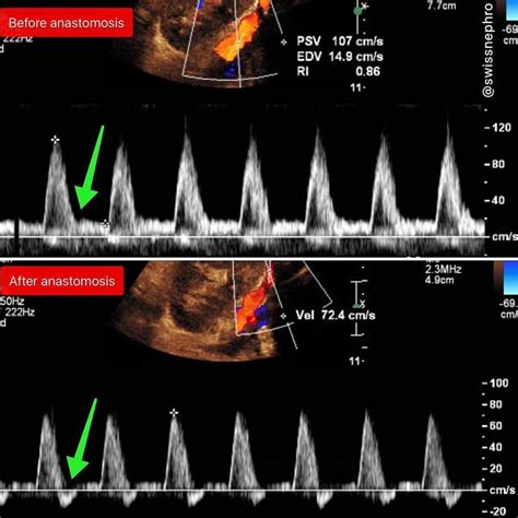 Lower Extremity Arterial Doppler Waveforms