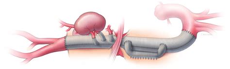 Open Surgical Repair Of An Extent Ii Thoracoabdominal Aortic Aneurysm Download Scientific