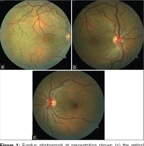 Figure From Favourable Outcome In Retinal Macrovessel Related