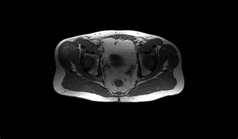 Soft Tissue Sarcoma Mri Radiology Article On Soft Tissue Sarcoma Mri