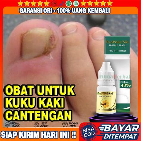 Jual Obat Kuku Cantengan Sakit Jempol Kaki Kuku Kaki Bengkak