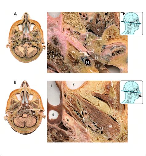 A. Tympanic orifice of the auditory tube; transverse section, superior ...