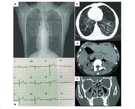 A Chest Radiograph Showing Dextrocardia B Electrocardiogram