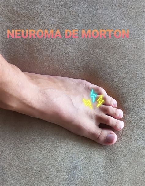 Neuroma De Morton No Todo El Dolor Del Pie Son Los Juanetes O Fascitis