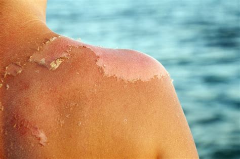 How To Treat And Heal Sunburn Fast Popsugar Beauty