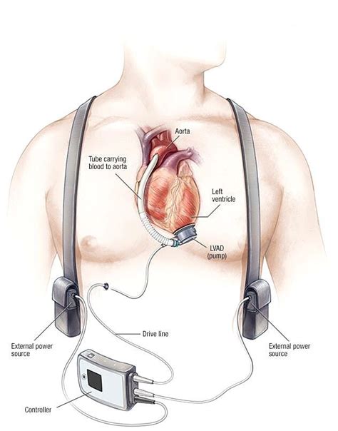 LVAD Device | Ventricular Assist Device Implant and Surgery