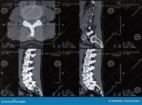 脊髓x 射线 库存照片 图片 包括有 脊椎 伤害 健康 椎骨 扫描 放射学 脱出 光芒 骨头的 52080806