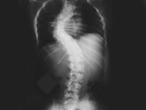 Advances In Scoliosis Treatment Are Changing Lives Disc Spine