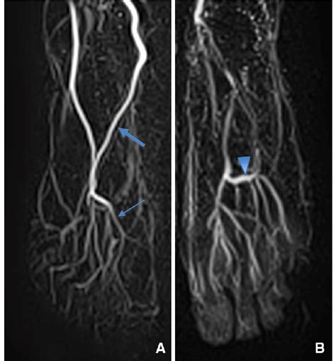 Dorsal Artery In Figure A Thick Arrow Showed Excellent Diagnostic