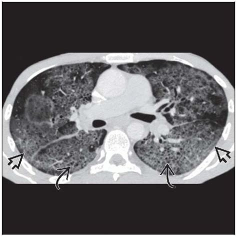 Pneumocystis Jiroveci Pneumonia Pcp