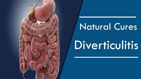 How To Treat Diverticulitis Naturally At Home Youtube