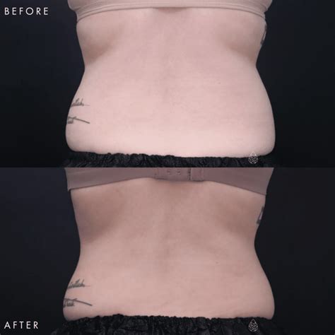 Las Vegas Coolsculpting Treatment Before After Pictures Sculpt Spa