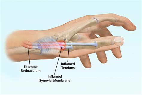 Tenosynovitis Causes Symptoms And Treatment