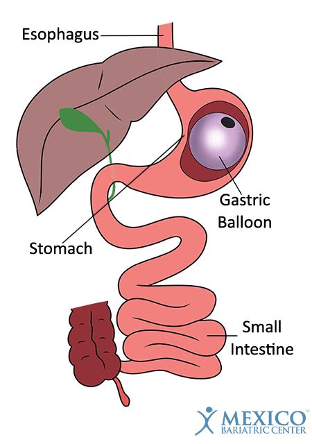 Gastric Balloon In Mexico Non Surgical Weight Loss System 2995