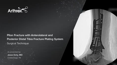 Arthrex Internal Fixation For Distal Tibia Fracture Pilon