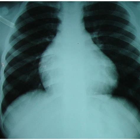 Chest X Ray Showing Severe Cardiomegaly And Right Atrium Enlargement