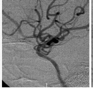 Left Initial Left Carotid Angiogram Lateral View Demonstrating