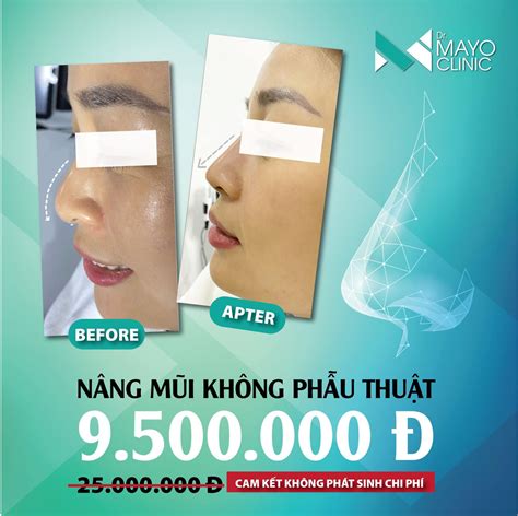 Dr - NÂNG MŨI KHÔNG PHẪU THUẬT BẰNG CHỈ SINH HỌC CÓ TỐT KHÔNG? Câu trả