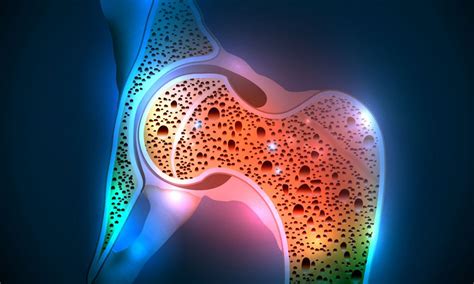 Osteoporosis Symptoms, Causes And Other Risk Factors