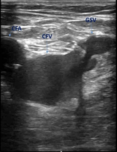 Point Of Care Ultrasonography Of The Left Lower Extremity At The Level