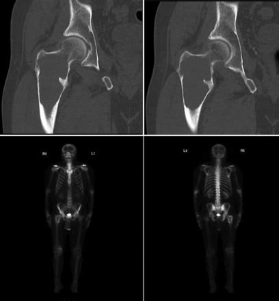 Proximal Femur Giant Solitary Plasmacytoma Of Bone Lessons Learnt