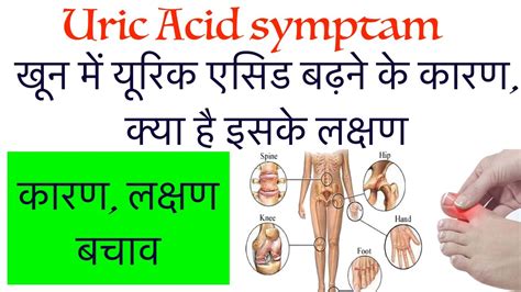 Uric Acid Symptomshow To Reduce Uric Acid Levelsgoutherbal Gout