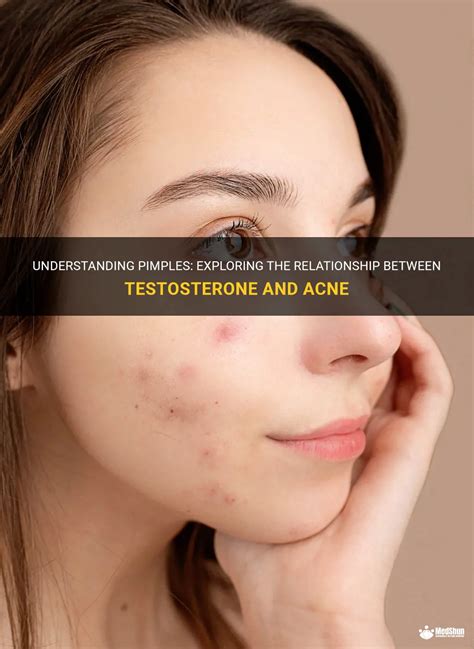 Understanding Pimples Exploring The Relationship Between Testosterone And Acne Medshun