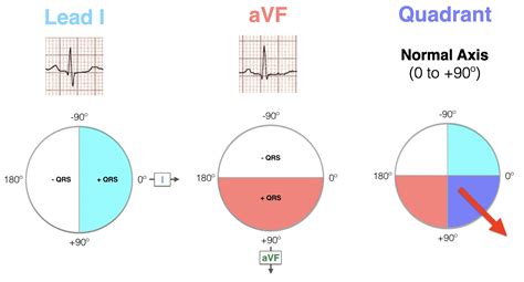 ECG Axis Interpretation • LITFL • ECG Library Basics