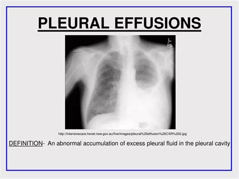 Ppt Pleural Effusions Powerpoint Presentation Free Download Id 2177030