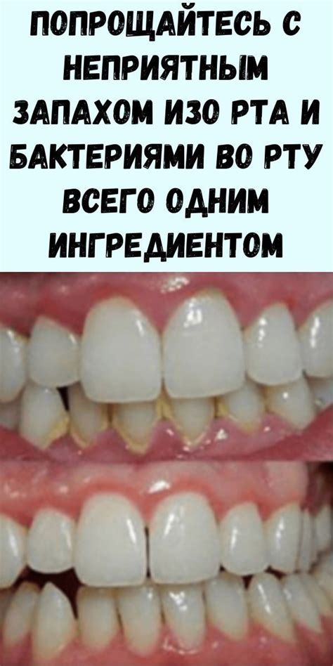 От чего образуются камни на зубах: Зубной камень — почему образуются и ...
