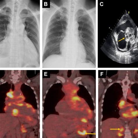 A Initial Chest X Ray At The Time Of Diagnosis Shows A Mediastinal Download Scientific