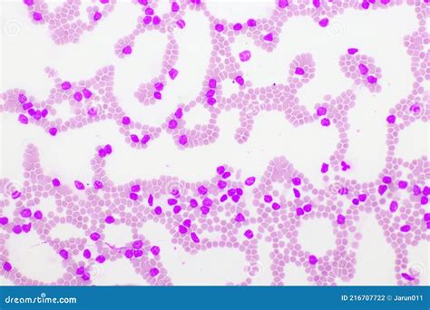 Picture Of Acute Lymphocytic Leukemia Or All Cells In Blood Smear Stock