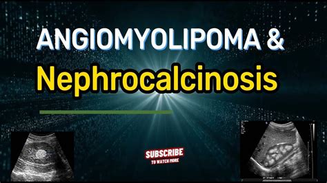 Angiomyolipoma And Nephrocalcinosis Ultrasound Echography Angiomyolipoma And Nephrocalcinosis Youtube