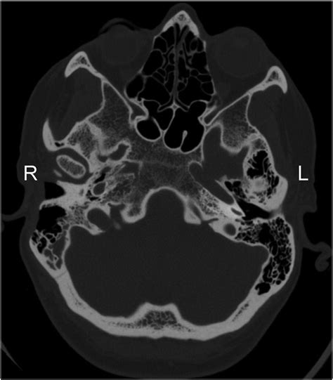 Axial Ct Imaging Showing Uninvolved And Normal Jugular Bulbs